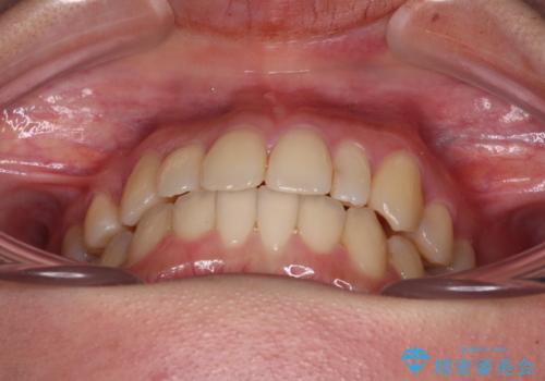 八重歯の抜歯矯正 補助装置を用いたインビザライン矯正の治療後