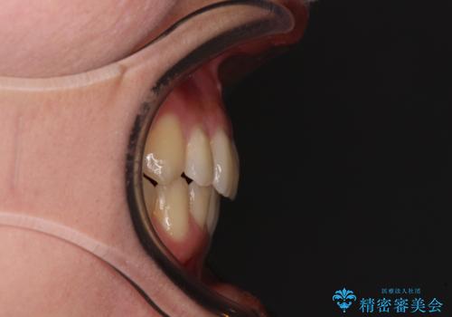 八重歯の抜歯矯正 補助装置を用いたインビザライン矯正の治療後