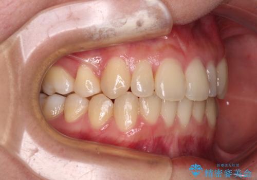 八重歯の抜歯矯正 補助装置を用いたインビザライン矯正の治療後