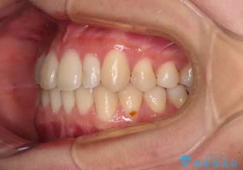 八重歯の抜歯矯正 補助装置を用いたインビザライン矯正の治療後