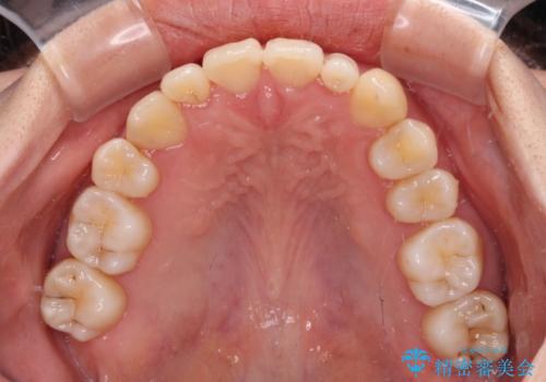 八重歯の抜歯矯正 補助装置を用いたインビザライン矯正の治療後