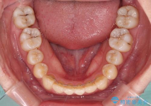 八重歯の抜歯矯正 補助装置を用いたインビザライン矯正の治療後