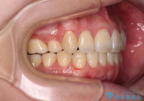 補助装置を使ったインビザラインによる抜歯矯正の治療後