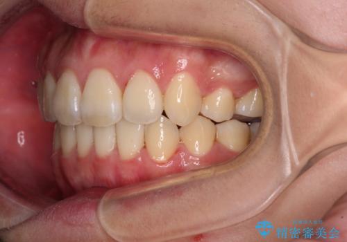 補助装置を使ったインビザラインによる抜歯矯正の治療後