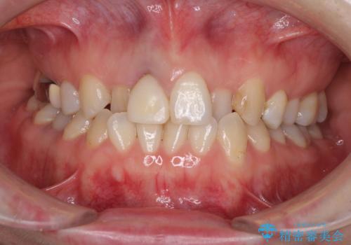 前歯のクロスバイトと治療が必要なむし歯 矯正とセラミックの総合歯科治療の症例 治療前