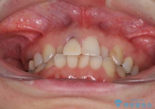 前歯のクロスバイトと治療が必要なむし歯 矯正とセラミックの総合歯科治療の治療前