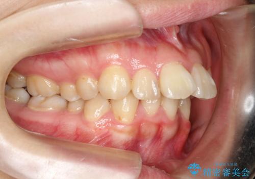 飛び出した前歯を引っ込めたい 目立たないワイヤーでの抜歯矯正の治療前