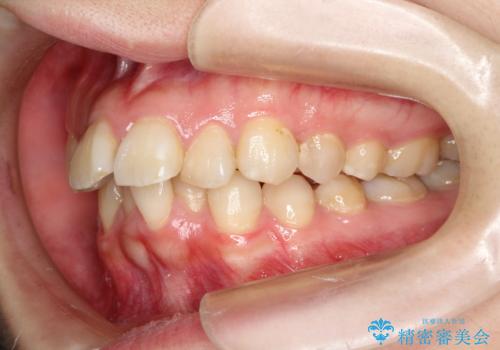 飛び出した前歯を引っ込めたい 目立たないワイヤーでの抜歯矯正の治療前