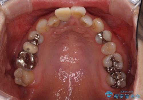 前歯のクロスバイトと治療が必要なむし歯 矯正とセラミックの総合歯科治療の治療前