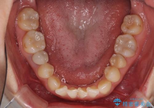 前歯のクロスバイトと治療が必要なむし歯 矯正とセラミックの総合歯科治療の治療前