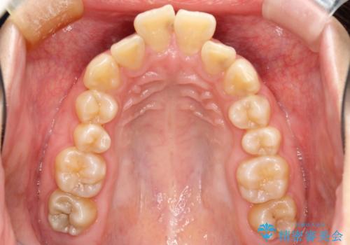 飛び出した前歯を引っ込めたい 目立たないワイヤーでの抜歯矯正の治療前