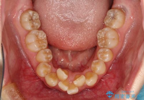 飛び出した前歯を引っ込めたい 目立たないワイヤーでの抜歯矯正の治療前