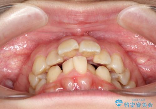飛び出した前歯を引っ込めたい 目立たないワイヤーでの抜歯矯正の治療前