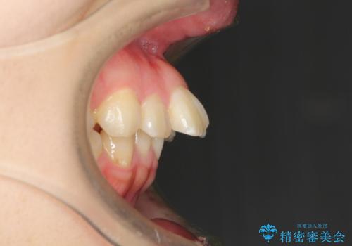 飛び出した前歯を引っ込めたい 目立たないワイヤーでの抜歯矯正の治療前