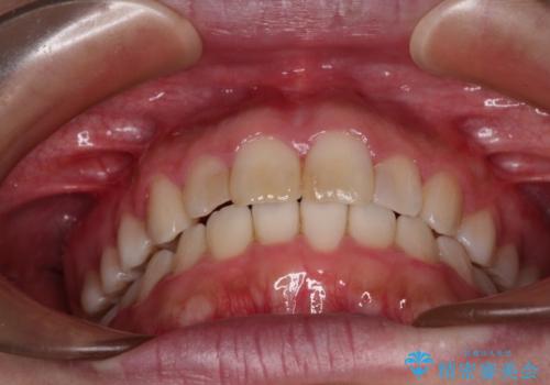 気になる前歯を治したい インビザラインで気づかれずに矯正治療の治療後