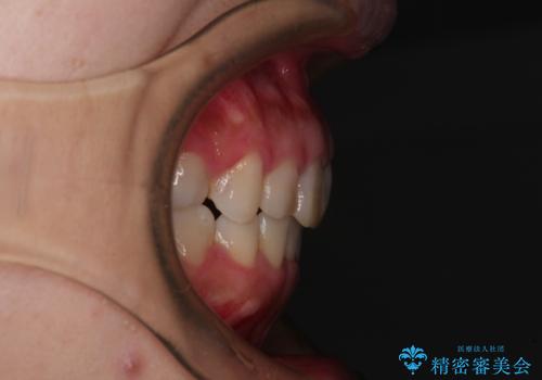 気になる前歯を治したい インビザラインで気づかれずに矯正治療の治療後