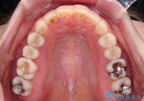 気になる前歯を治したい インビザラインで気づかれずに矯正治療の治療後