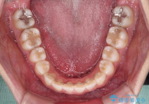 気になる前歯を治したい インビザラインで気づかれずに矯正治療の治療後