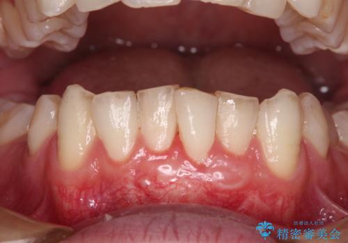 ほぼ歯根全てが露出　2度の歯肉移植術で自然な見た目にの症例 治療後