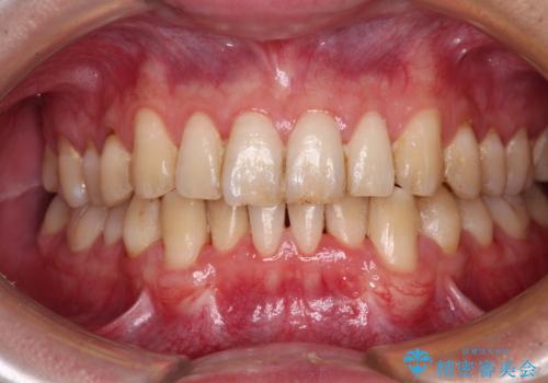 しみてしまう下顎の犬歯 歯肉移植による根面被覆の治療後