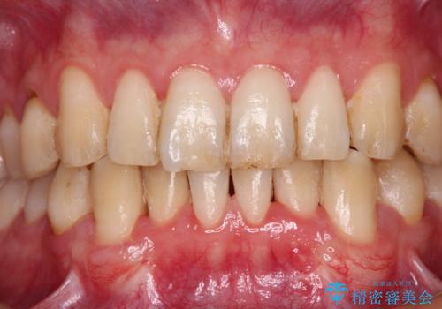 しみてしまう下顎の犬歯 歯肉移植による根面被覆の治療後