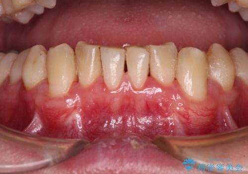 しみてしまう下顎の犬歯　歯肉移植による根面被覆の治療後