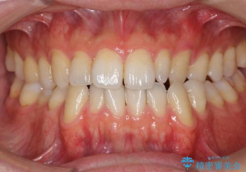 前歯の矮小歯 奥歯の反対咬合 をインビザラインでの治療前