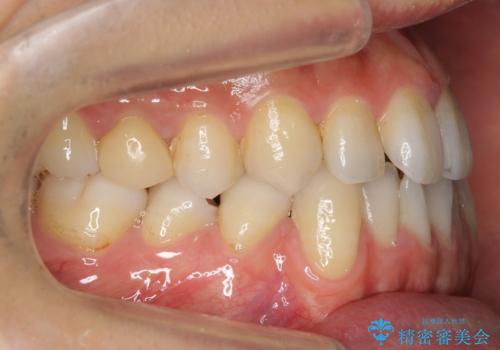 前歯の矮小歯 奥歯の反対咬合 をインビザラインでの治療前