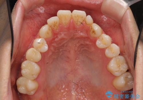 前歯の矮小歯　奥歯の反対咬合　をインビザラインでの治療前