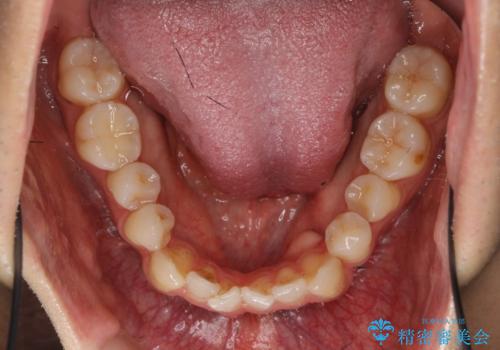 前歯の矮小歯 奥歯の反対咬合 をインビザラインでの治療前