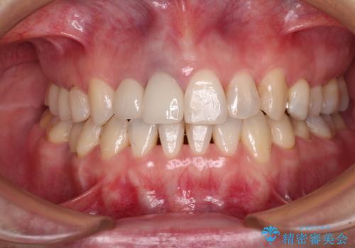 前歯のクロスバイトと治療が必要なむし歯　矯正とセラミックの総合歯科治療