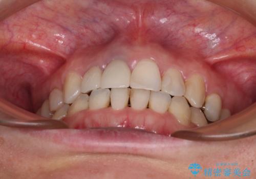 前歯のクロスバイトと治療が必要なむし歯 矯正とセラミックの総合歯科治療の治療後