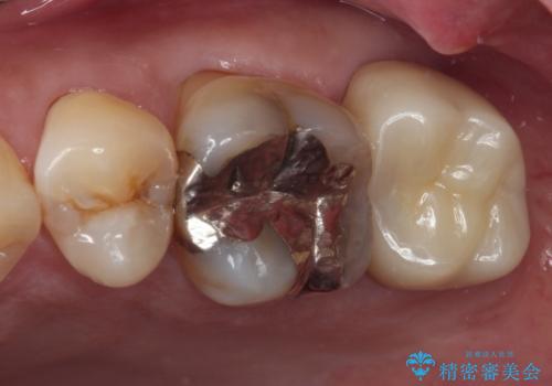 歯に穴が空いてしみる　ものが挟まってしまうほど大きな奥歯のむし歯の症例 治療後