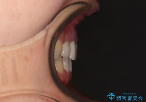 前歯のクロスバイトと治療が必要なむし歯 矯正とセラミックの総合歯科治療の治療後