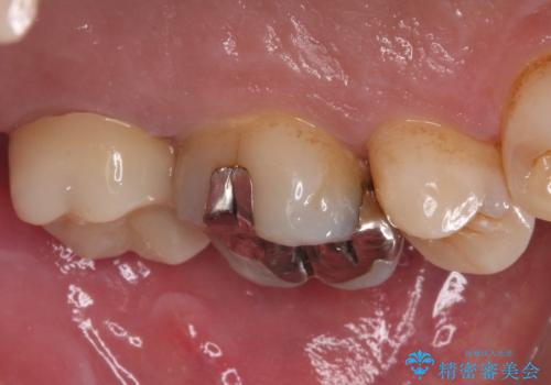 歯に穴が空いてしみる ものが挟まってしまうほど大きな奥歯のむし歯の治療後