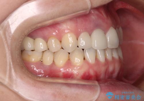 前歯のクロスバイトと治療が必要なむし歯 矯正とセラミックの総合歯科治療の治療後