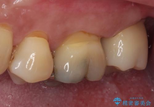歯に穴が空いてしみる ものが挟まってしまうほど大きな奥歯のむし歯の治療後