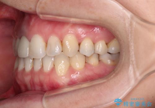 前歯のクロスバイトと治療が必要なむし歯 矯正とセラミックの総合歯科治療の治療後