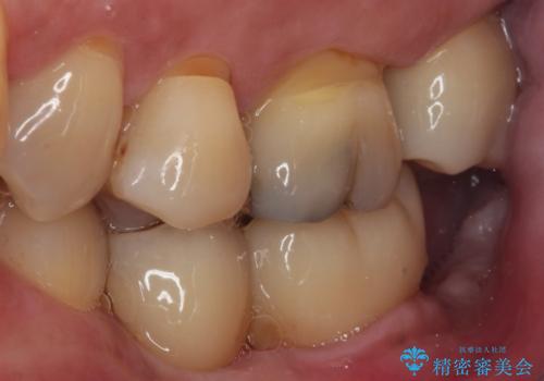 歯に穴が空いてしみる　ものが挟まってしまうほど大きな奥歯のむし歯の治療後