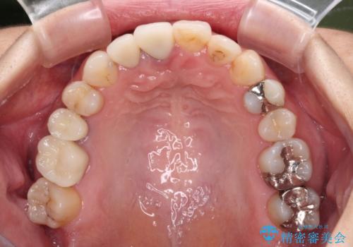 前歯のクロスバイトと治療が必要なむし歯 矯正とセラミックの総合歯科治療の治療後