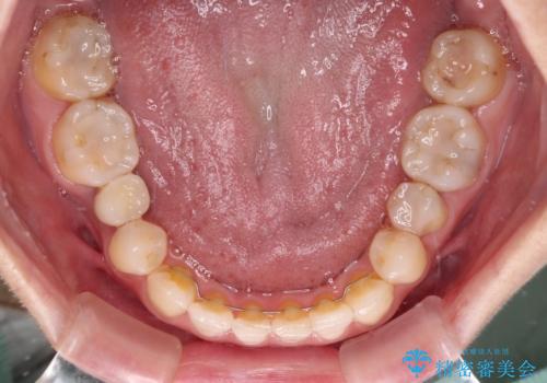 前歯のクロスバイトと治療が必要なむし歯 矯正とセラミックの総合歯科治療の治療後