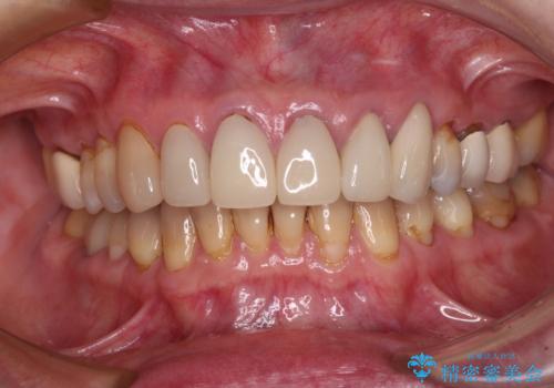 もげてしまった前歯をセラミッククラウンで自然にの治療後