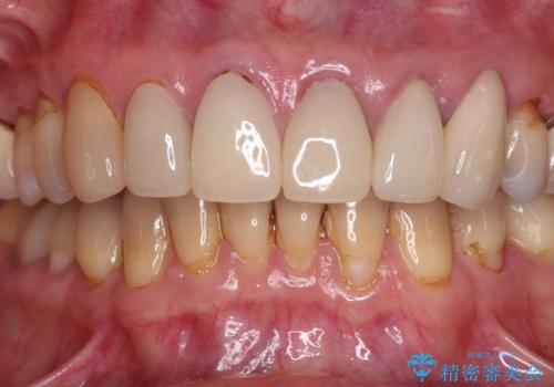 もげてしまった前歯をセラミッククラウンで自然にの治療後