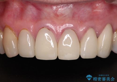 もげてしまった前歯をセラミッククラウンで自然にの症例 治療後