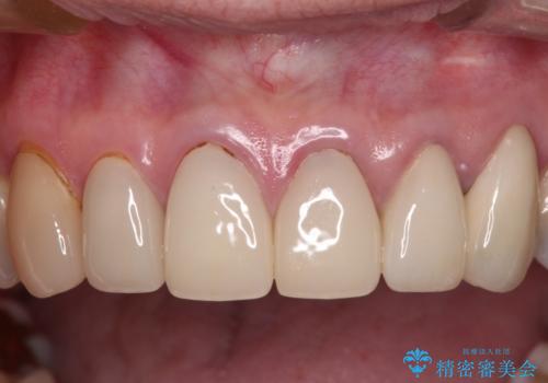 もげてしまった前歯をセラミッククラウンで自然にの治療後