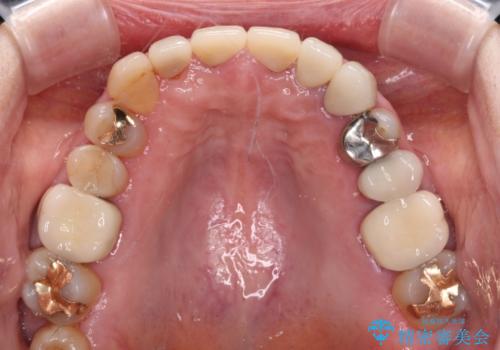 もげてしまった前歯をセラミッククラウンで自然にの治療後