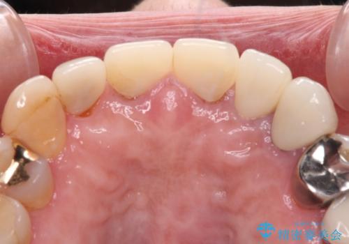 もげてしまった前歯をセラミッククラウンで自然にの治療後