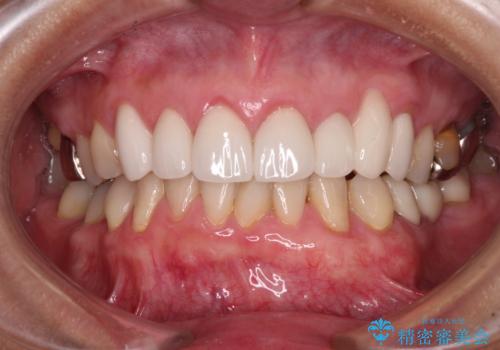 歯磨きの度にしみる歯　露出した歯根を歯肉移植で改善の治療後