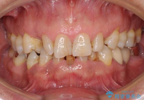 乳歯や矮小歯の多い前歯 部分矯正と補綴治療による審美歯科治療の治療前