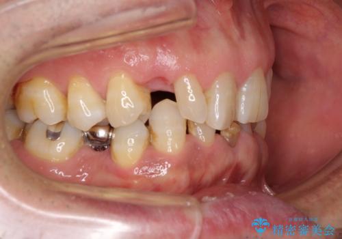 乳歯や矮小歯の多い前歯 部分矯正と補綴治療による審美歯科治療の治療前